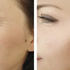 Comparación antes y después de radiofrecuencia facial: piel con arrugas profundas y piel visiblemente más lisa y rejuvenecida.
