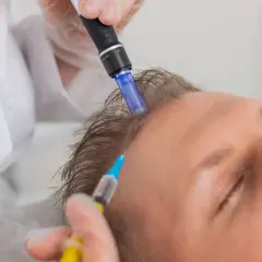 Un profesional realiza microneedling capilar en la cabeza de un hombre, aplicando un tratamiento para estimular el crecimiento del cabello.