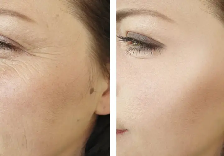 Comparación antes y después de radiofrecuencia facial: piel con arrugas profundas y piel visiblemente más lisa y rejuvenecida.