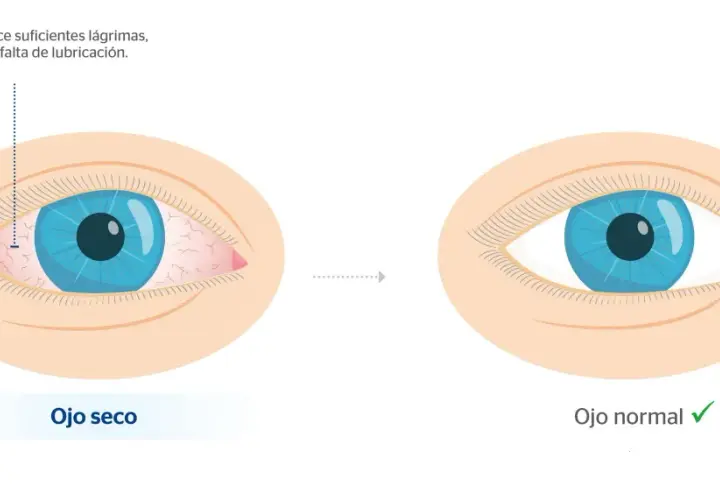 Ojo seco con irritación y enrojecimiento, comparado con un ojo normal y lubricado. Evita los ojos hinchados por la mañana.