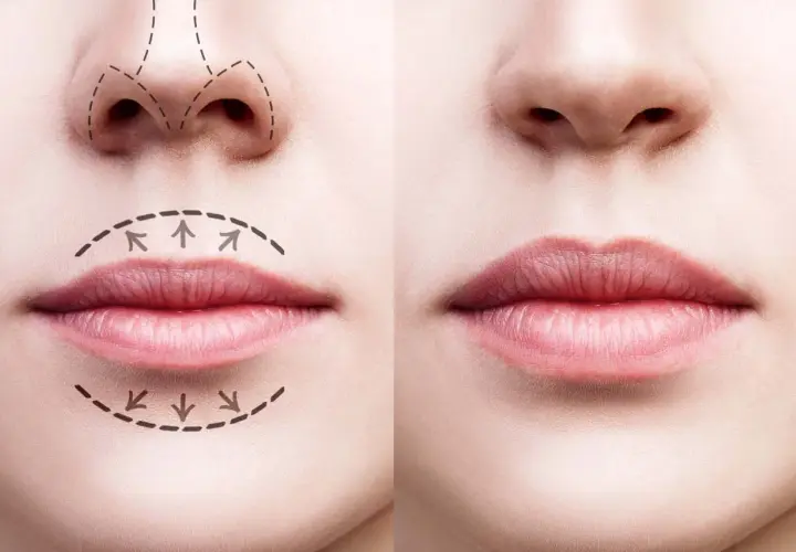 Comparativa de labios antes y después de ácido hialurónico. Muestra diferentes tipos de labios y cómo el relleno mejora su volumen y forma.
