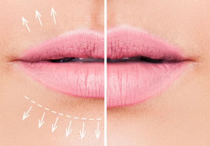 Antes y después de un tratamiento para realzar los labios finos. Flechas indican el aumento de volumen.