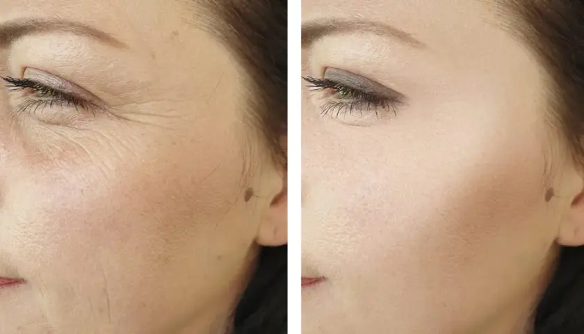 Comparación antes y después de radiofrecuencia facial: piel con arrugas profundas y piel visiblemente más lisa y rejuvenecida.