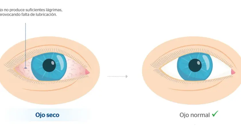 Ojo seco con irritación y enrojecimiento, comparado con un ojo normal y lubricado. Evita los ojos hinchados por la mañana.