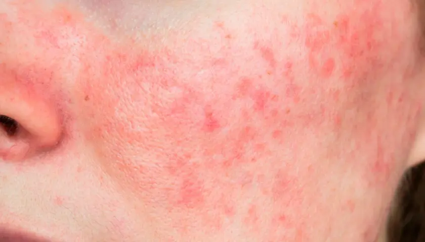 Rostro con enrojecimiento y pequeños bultos, indicativo de rosacea leve.