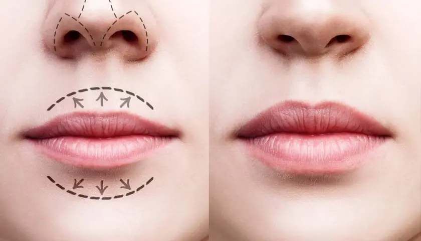 Comparativa de labios antes y después de ácido hialurónico. Muestra diferentes tipos de labios y cómo el relleno mejora su volumen y forma.