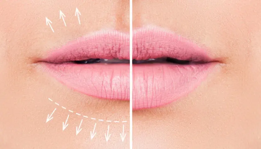 Antes y después de un tratamiento para realzar los labios finos. Flechas indican el aumento de volumen.