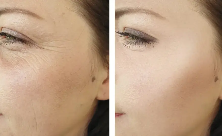 Radiofrecuencia facial - Firmeza sin cirugía, resultados y precios