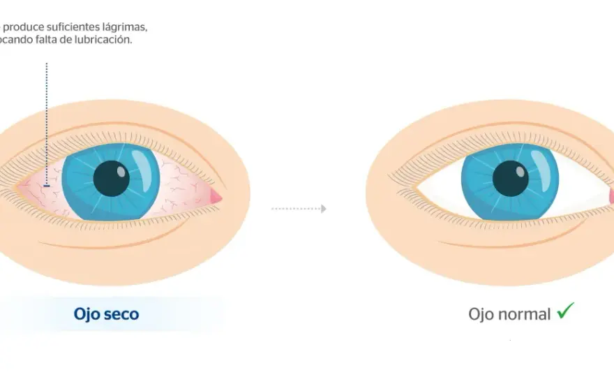 Ojos hinchados al despertar - causas, remedios y señales de alerta