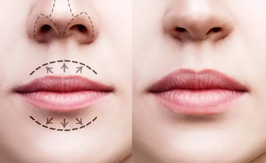Labios con ácido hialurónico - Guía de resultados, técnicas y precios