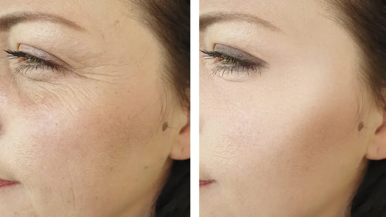 Comparación antes y después de radiofrecuencia facial: piel con arrugas profundas y piel visiblemente más lisa y rejuvenecida.