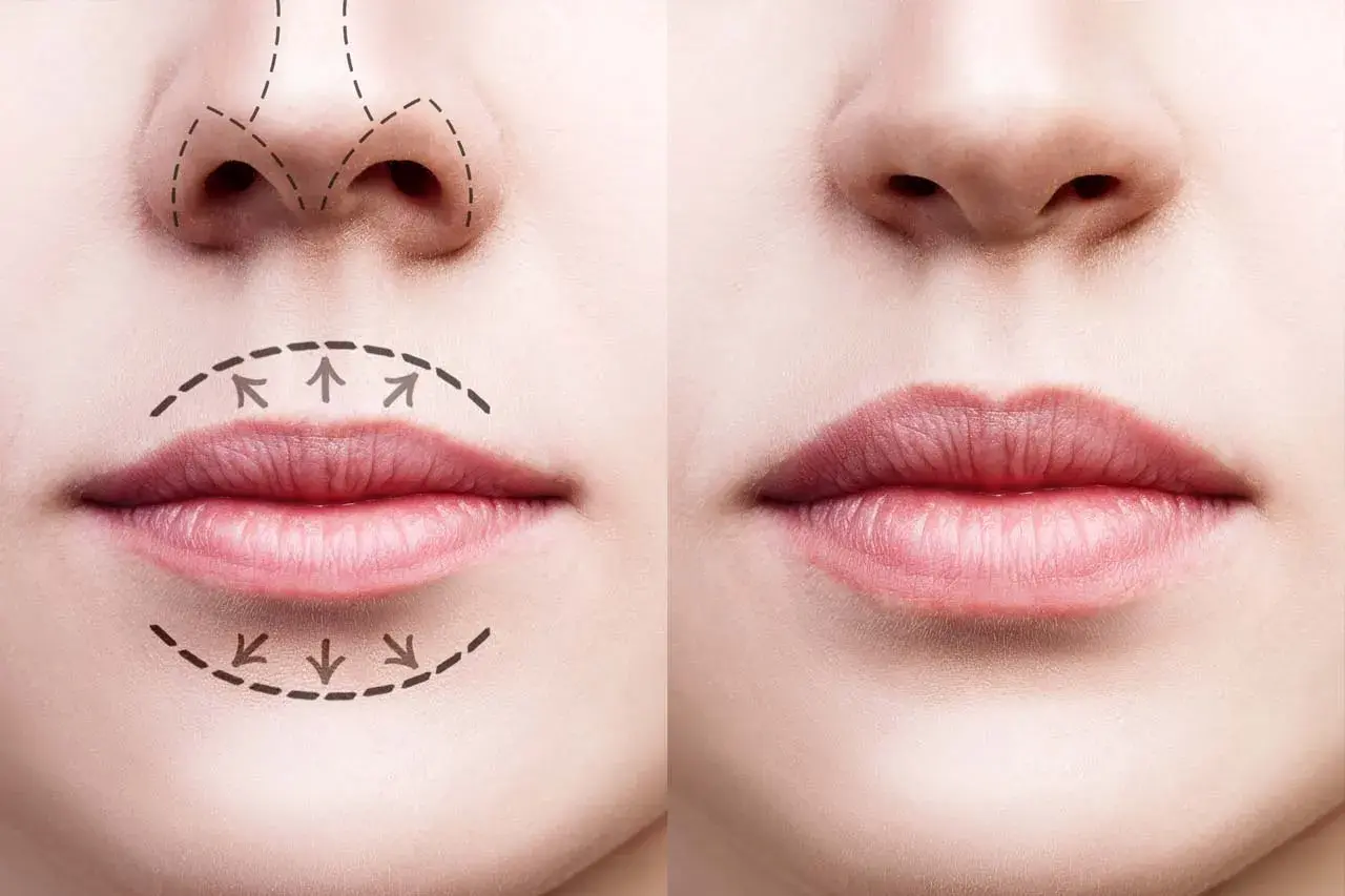 Comparativa de labios antes y después de ácido hialurónico. Muestra diferentes tipos de labios y cómo el relleno mejora su volumen y forma.