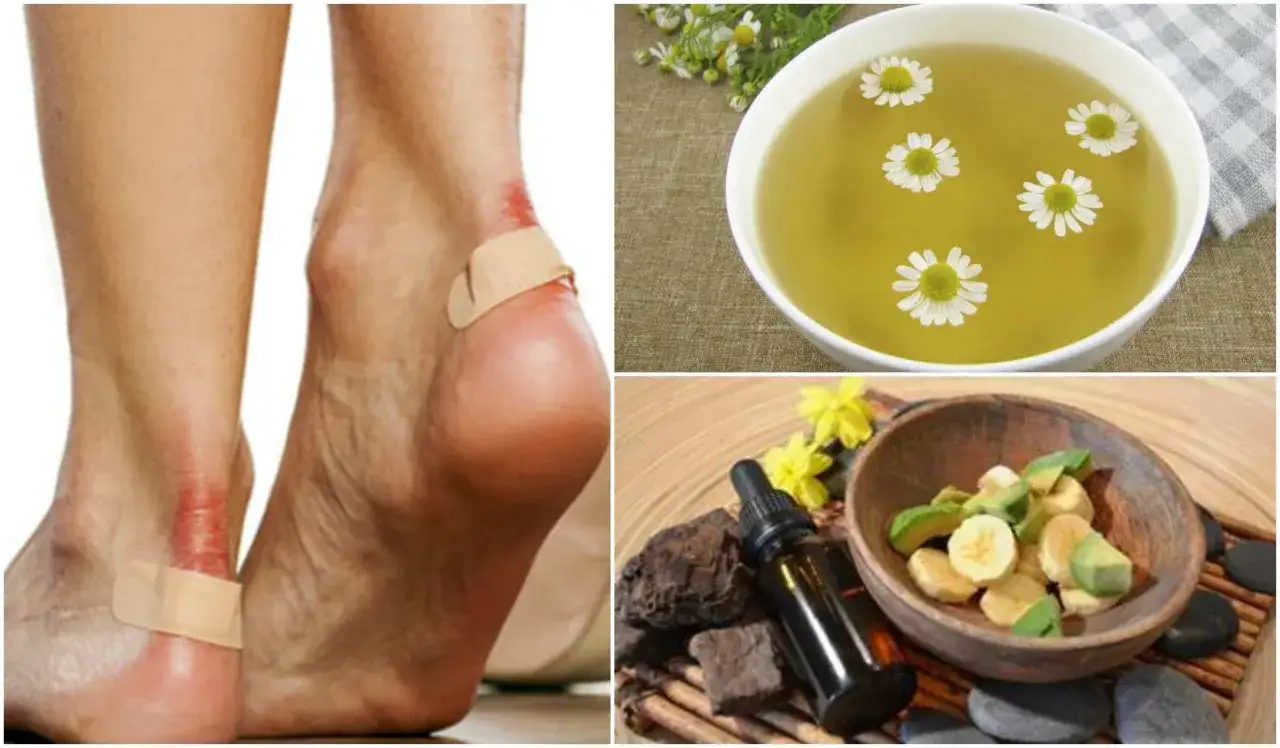 Alivio para rozaduras de zapatos en piel: curas naturales con manzanilla y ingredientes frescos.