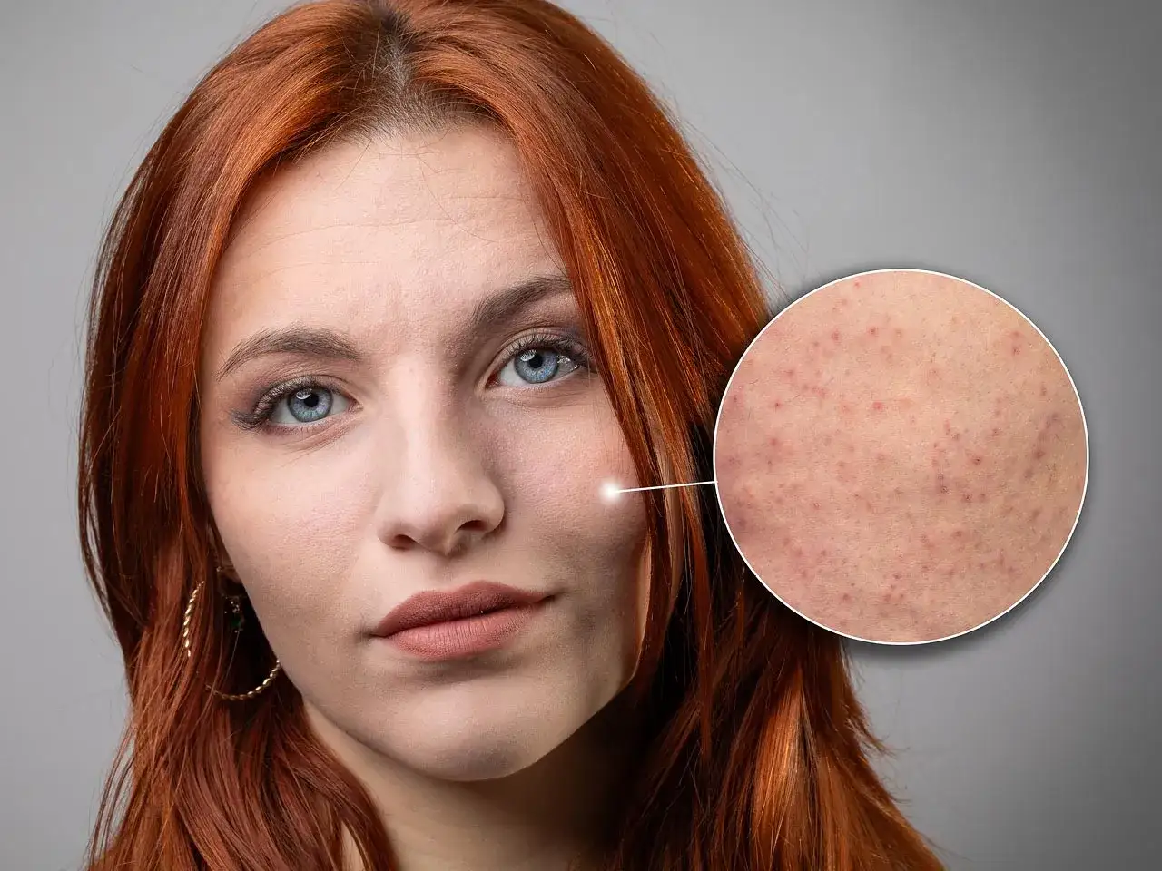 Primer plano de una mujer con cabello pelirrojo y ojos azules. Un círculo amplía una zona de su mejilla, mostrando una piel con pequeñas imperfecciones, similar a la piel de fresa.
